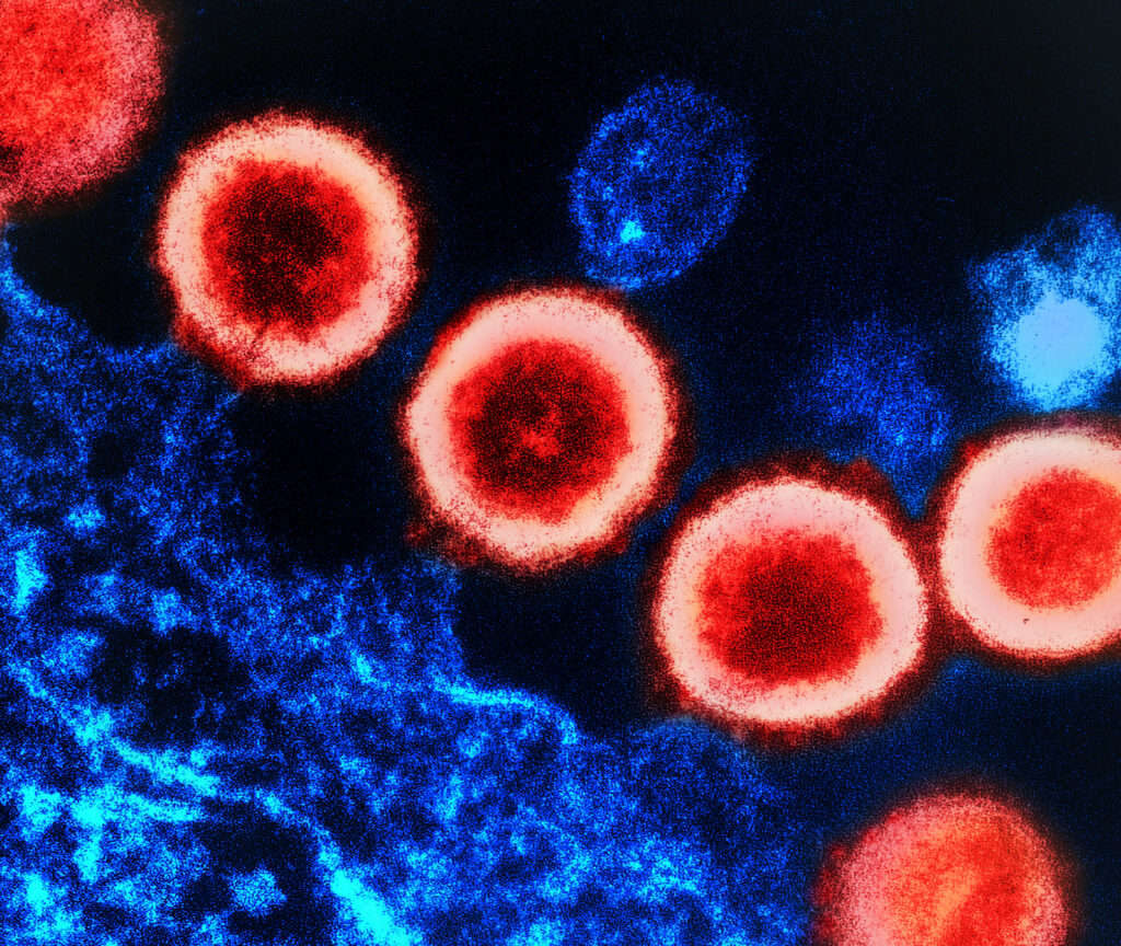 An electron microscope image showing the HIV virus. It has a dark red inner core and lighter red outer membrane. 